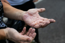 Ultra Radfahrer und Keynote Speaker Christoph Strasser mit wunden Händen